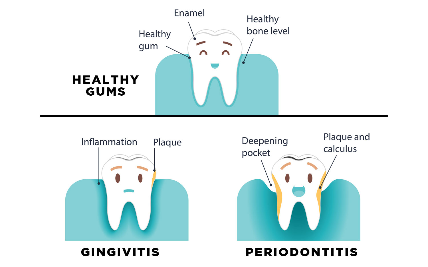 Stages Of Gum Disease