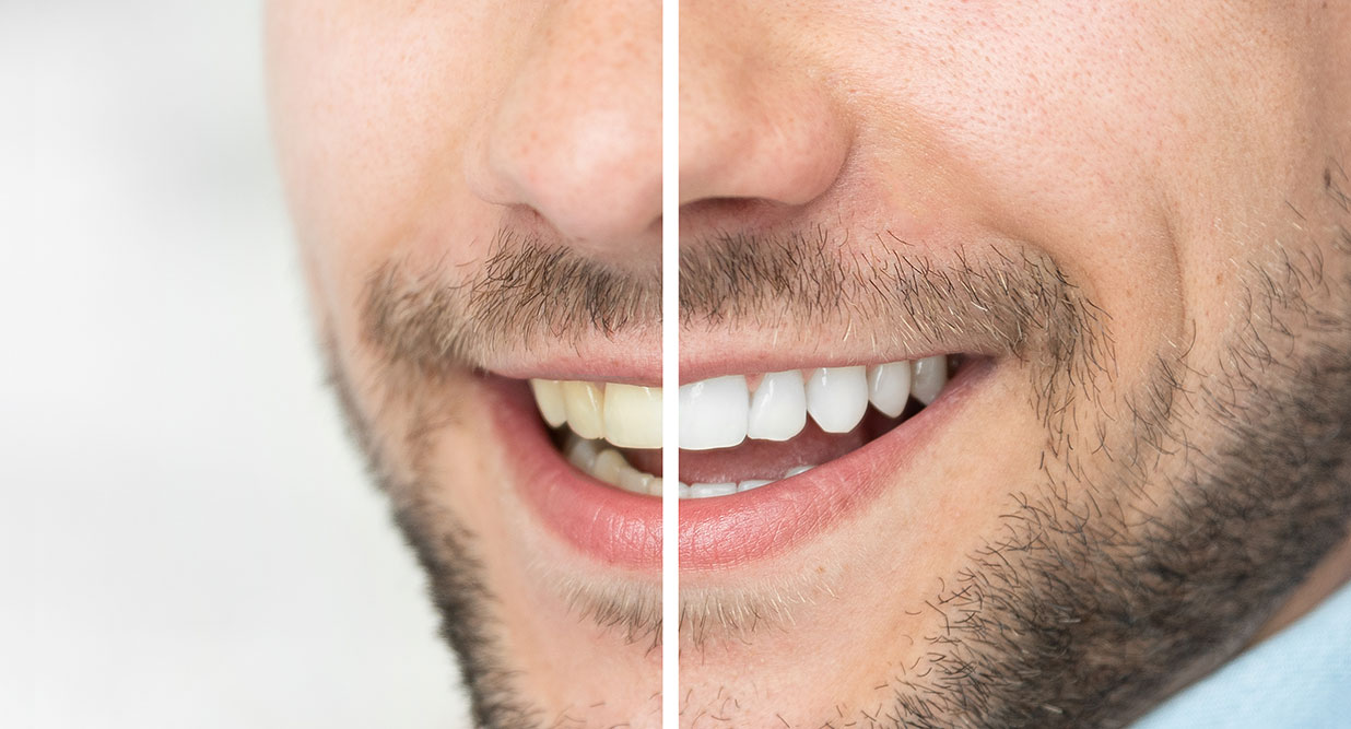 Teeth Whitening Cosmetic Dentist Auckland